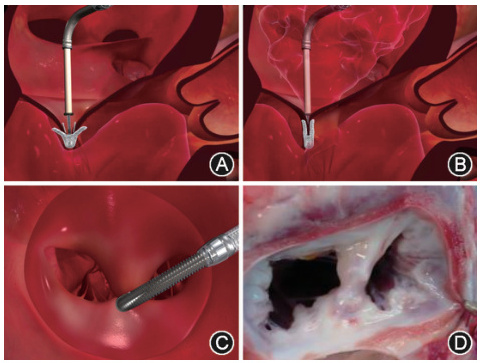 經(jīng)導(dǎo)管二尖瓣夾系統(tǒng)醫(yī)療器械注冊(cè)證辦理指南(圖2)