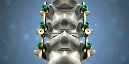 脊柱后路內(nèi)固定系統(tǒng)注冊(cè)技術(shù)審查指導(dǎo)原則(2016年第70號(hào))(圖1) 脊柱后路內(nèi)固定系統(tǒng)注冊(cè)技術(shù)審查指導(dǎo)原則(2016年第70號(hào))(圖1)